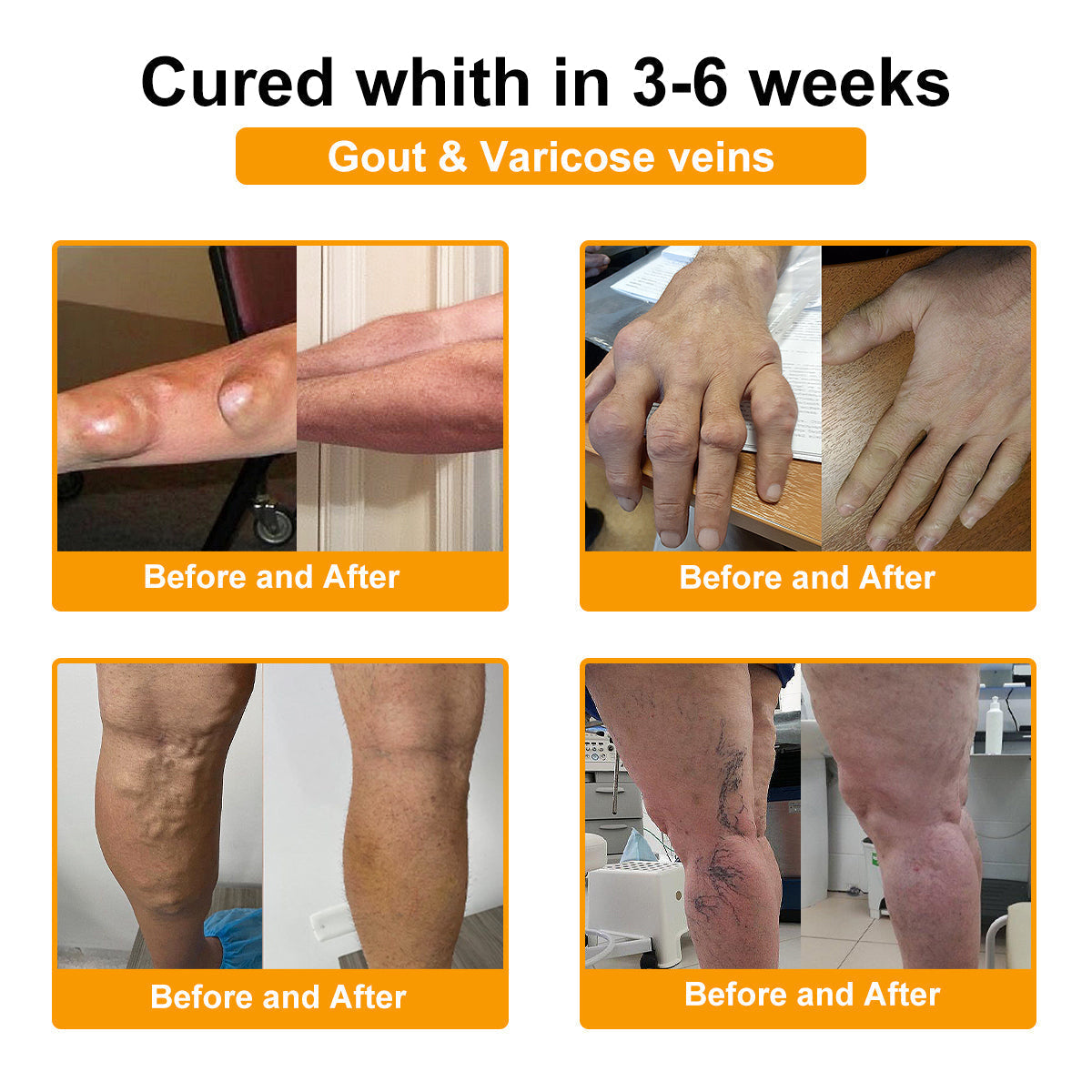 🎁💎Flash Sale - ODALIT™ Botulinum Toxin & Bee Venom Pain-Relief Bone Healing Cream🐝