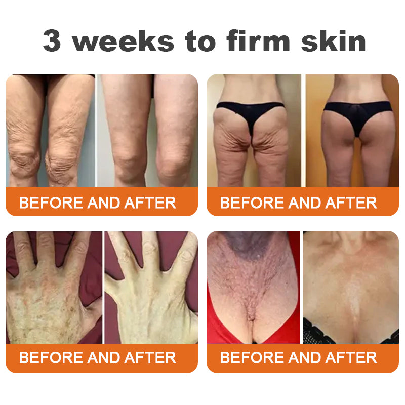 đđFlash Sale - â¨ODEIUN⢠BOTOX Bee Venom All-in-one Treatment Cream đĽ LAST DAY 80% OFF đđ